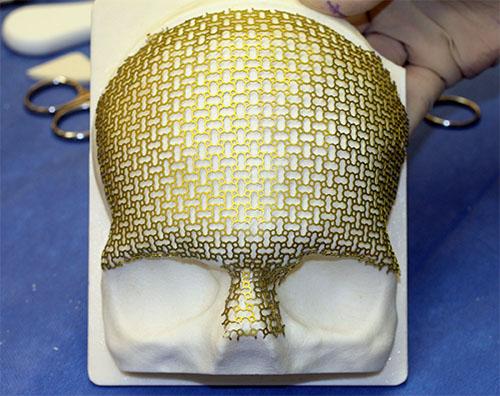 Custom titanium mesh implant by Calavera Surgical Design