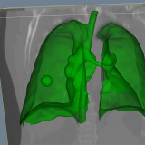CIMTEC developed 3D lung tumour segmentation software