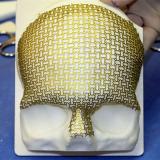 Custom titanium mesh implant by Calavera Surgical Design