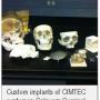 Custom Implants of CIMTEC customer, Calavera Surgical Design