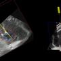 CIMTEC developed 3D ultrasound needle guidance system